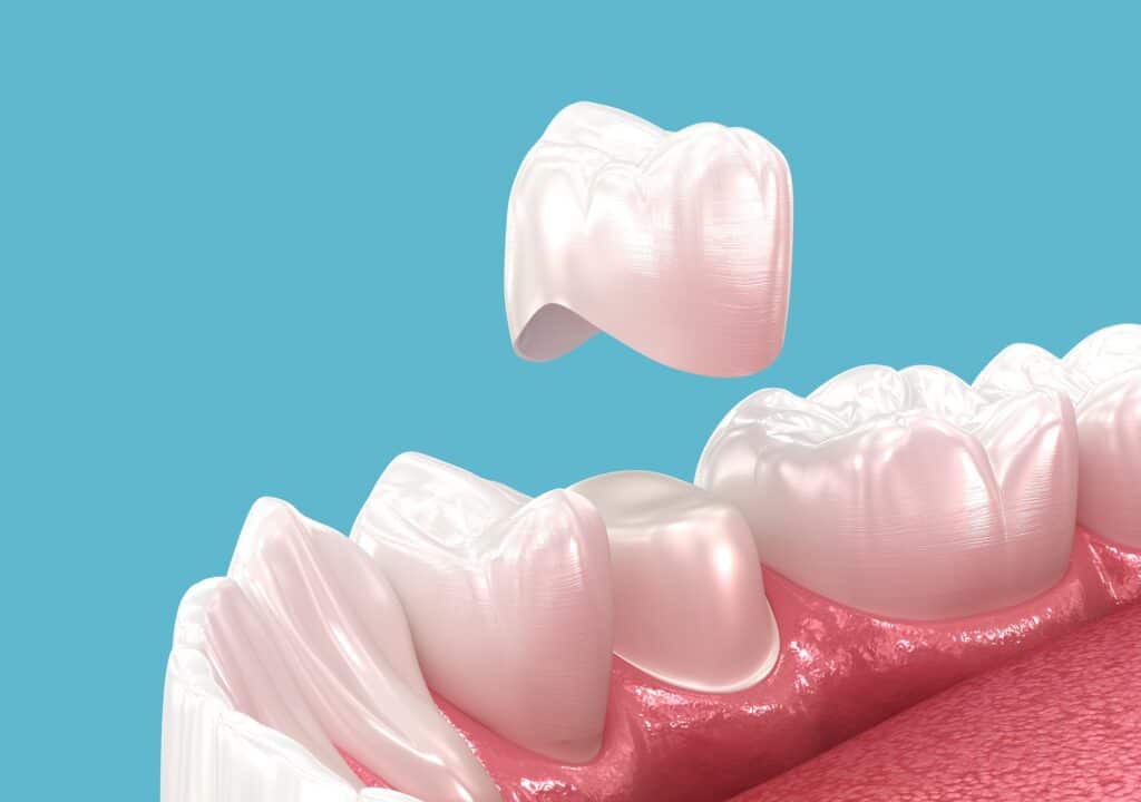 How Dental Crowns Restore Damaged Teeth