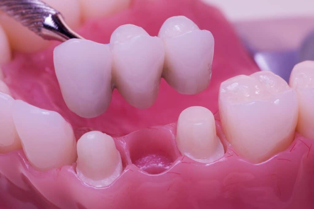What Happens If You Ignore a Missing Tooth?