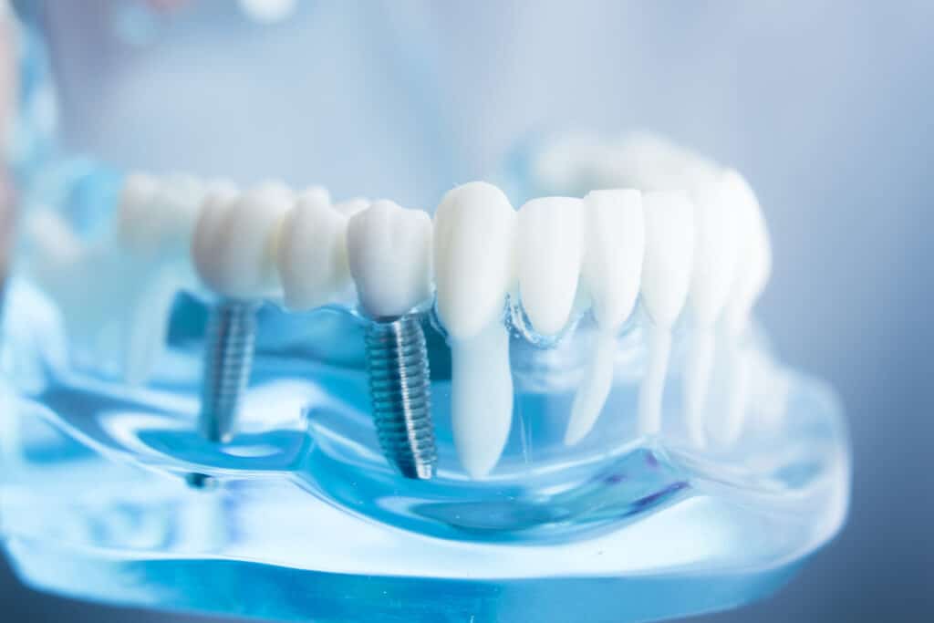 What to Expect During a Root Canal Procedure