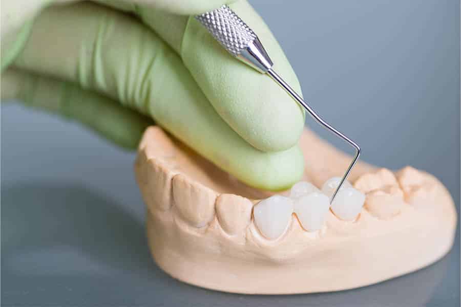 Close-up of dental implant and prosthodontic model
