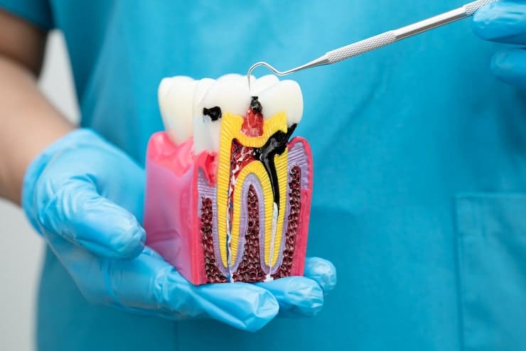 Root canal treatment at North Pointe Dental Center